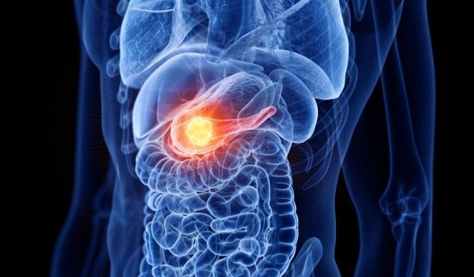 CÂNCER DE PÂNCREAS: NOVO ESTUDO REVELA PROTEÍNA CRUCIAL CÂNCER DE PÂNCREAS: NOVO ESTUDO REVELA PROTEÍNA CRUCIAL