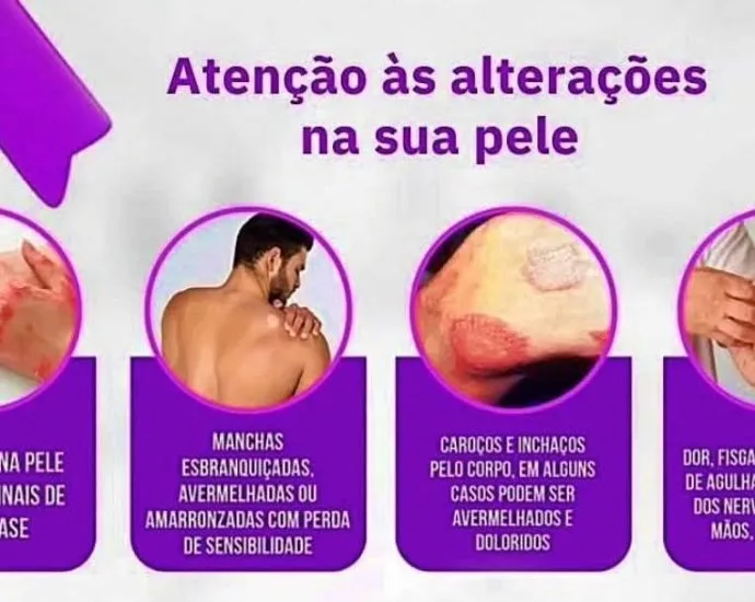 HANSENÍASE: SECRETARIA DE SAÚDE DE CASTILHO PROMOVE CAMPANHA