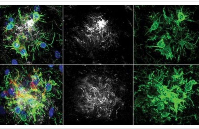 ALZHEIMER: NOVA PESQUISA RETARDA PERDA DE MEMÓRIA ALZHEIMER: NOVA PESQUISA RETARDA PERDA DE MEMÓRIA