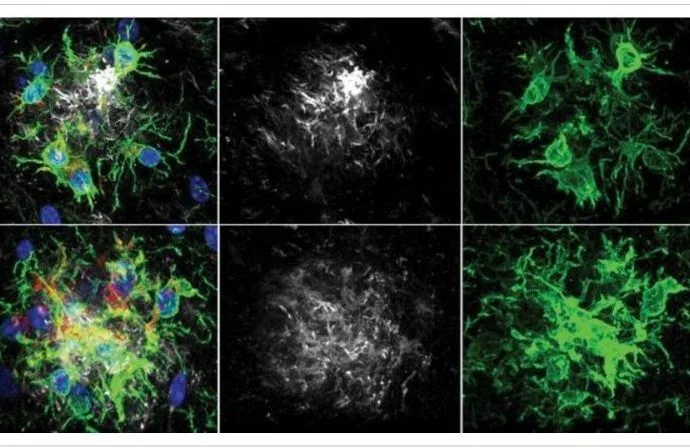 ALZHEIMER: NOVA PESQUISA RETARDA PERDA DE MEMÓRIA ALZHEIMER: NOVA PESQUISA RETARDA PERDA DE MEMÓRIA
