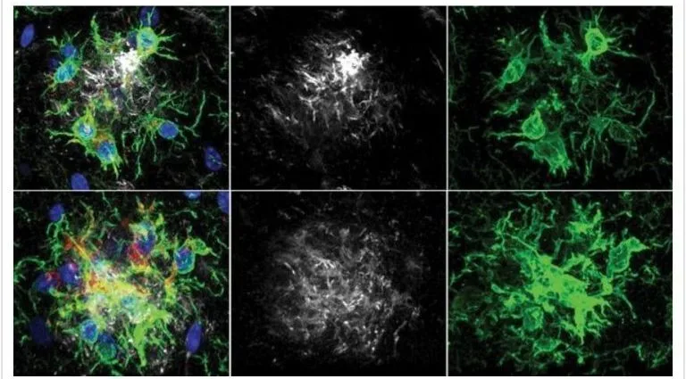 ALZHEIMER: NOVA PESQUISA RETARDA PERDA DE MEMÓRIA
