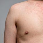 São Paulo Registra Primeiro Caso de Sarampo em 2026