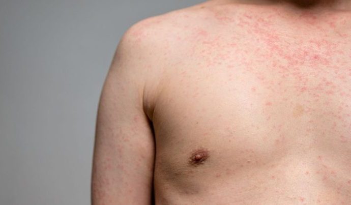 São Paulo Registra Primeiro Caso de Sarampo em 2026