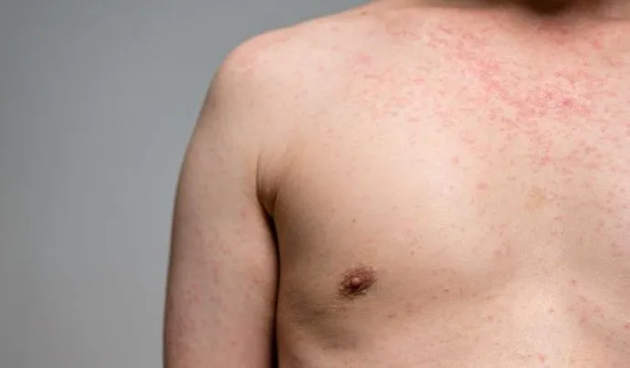 São Paulo Registra Primeiro Caso de Sarampo em 2026