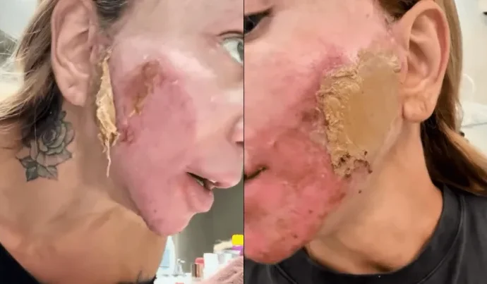 Maya Massafera Compartilha Experiência com Procedimento Estético Agressivo