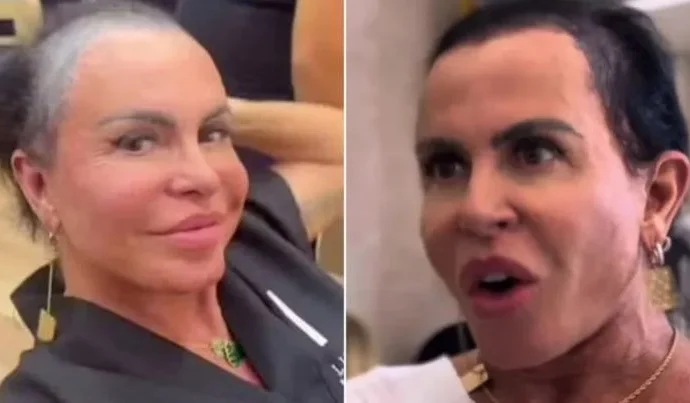 Gretchen compartilha desafios no tratamento contra alopecia após micropigmentação