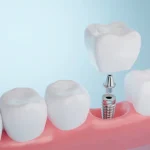 PERDEU UM DENTE? VEJA 5 FATORES QUE PODEM CAUSAR PERDA ÓSSEA NA BOCA