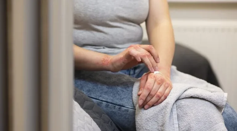 CONSCIENTIZAÇÃO SOBRE O LÚPUS: DOENÇA INVISÍVEL ATINGE PRINCIPALMENTE MULHERES CONSCIENTIZAÇÃO SOBRE O LÚPUS: DOENÇA INVISÍVEL ATINGE PRINCIPALMENTE MULHERES