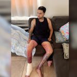 Jovem de Votuporanga recebe alta após queimaduras em explosão com etanol