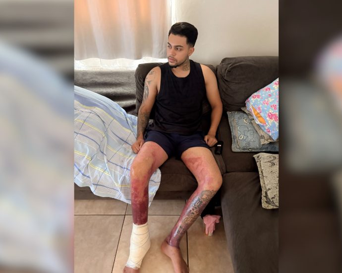Jovem de Votuporanga recebe alta após queimaduras em explosão com etanol